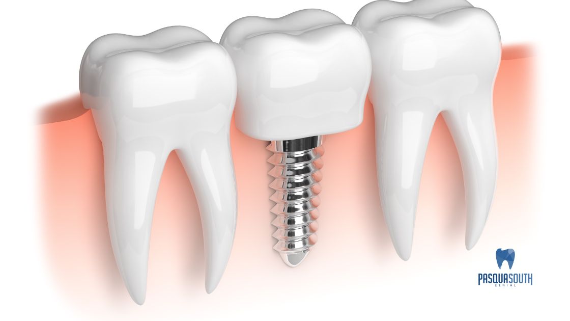 Dental implant process
