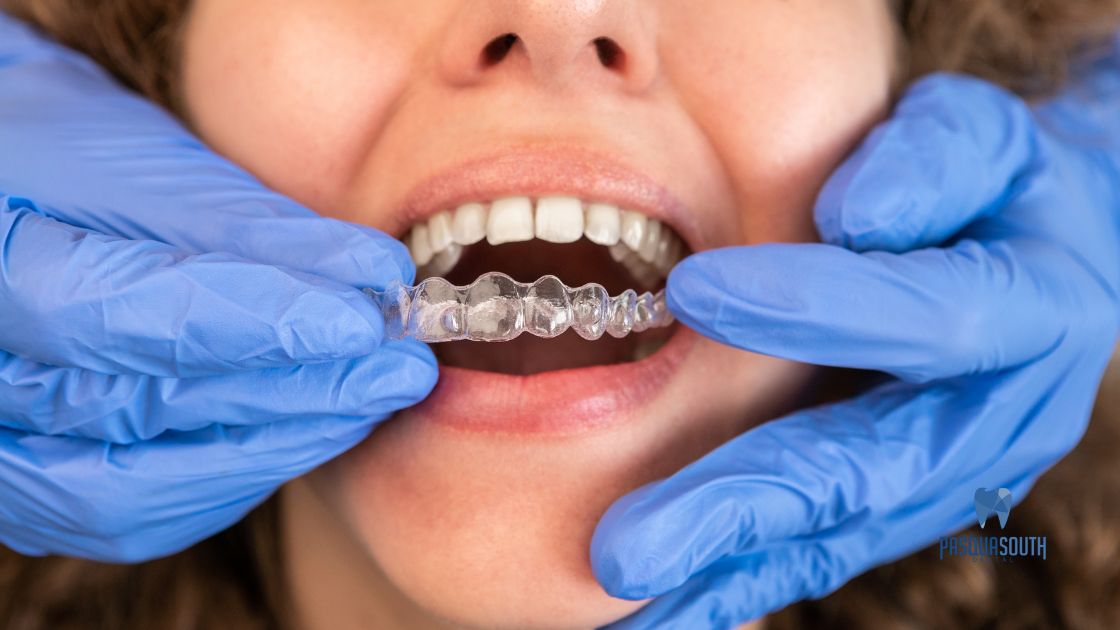 Invisalign Clear Aligners treatment 