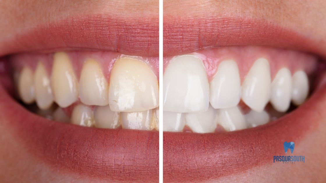 Tooth whitening