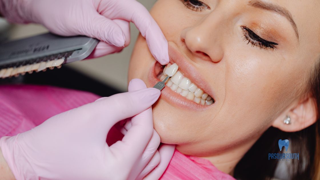 Dental veneers procedure