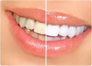 before and after image of teeth when they are whitened