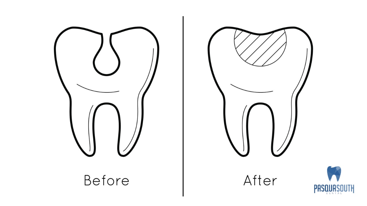 dental filling