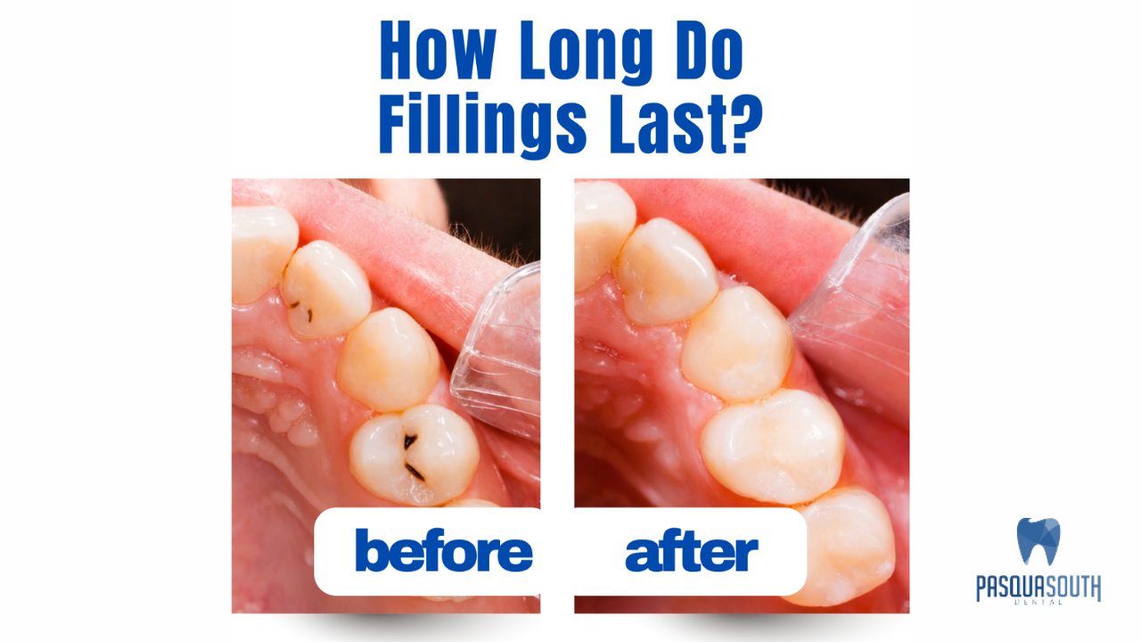 How Long Do Fillings Last